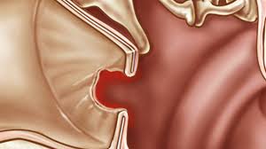 Your eardrum (tympanic membrane) has two primary roles: How To Treat A Perforated Ear Drum Howcast