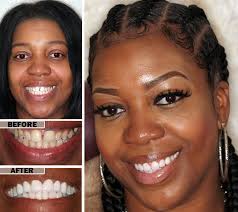 Toothpaste that gives you a healthy smile, with specialized solutions tailored to you. Root Canal Procedure Cost Pain Retreatment Dentist In Brooklyn