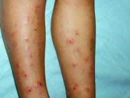 Image result for Papular urticaria