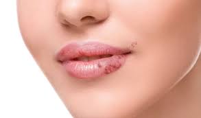 Herpes Labial Et Zona Differences Origine Et Traitements