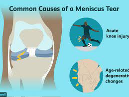 What is a meniscus and what does it do? Meniscus Tears Symptoms Causes Diagnosis And Treatment