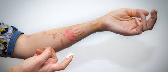 Quemaduras Con Aceite Como Evitar Que Salgan Manchas En La Piel Bekia Belleza