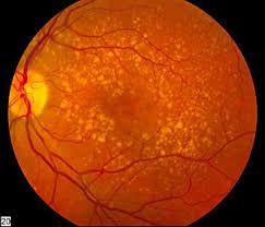 Macular Degeneration Wikipedia