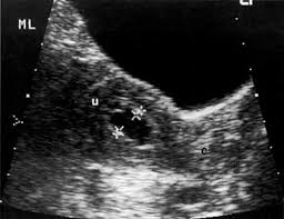 What will i experience during and after the procedure? Volume 4 Chapter 54 Radiology In The Diagnosis Staging And Management Of Gynecologic Malignancies