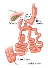 Bariatric surgery, along with other weight loss procedures have become more routine and are no longer considered experimental, but does your health insurance cover the cost? Bariatric Center Adds Duodenal Switch Surgery