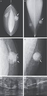 Male breast cancer is cancer that develops in the breast tissue of men. Can Men Have Breast Cancer Do They Have Breasts Medizzy Journal