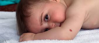 Blutschwammchen Bei Babys Hamangiom Pampers