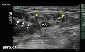 Image result for Axillary Nerve Block