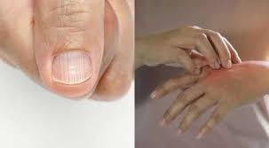What are the symptoms of omicron? Omicron Skin Lips And Nail Symptoms That Mean You Need Urgent Covid 19 Treatment Science News Wionews Com