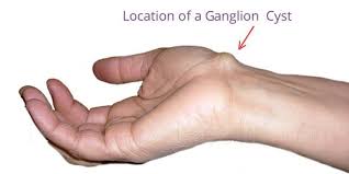 Ganglion cysts are commonly found on the wrist and 80% on women. Ganglion Cyst Bio Ceramic Infrared Home Remedy Reduces Lump On Wrist Farinfraredhealth Com