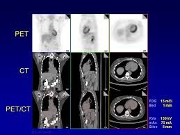 Maybe you would like to learn more about one of these? Pet Ct In Oncology George Segall M D Stanford University Ppt Video Online Download