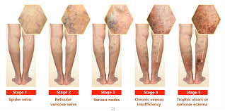 Insuficiența Venoasă Cronică Vascular Renew