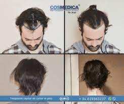 L'unica differenza è nel fatto che il capo del . Rasare I Capelli Per Il Trapianto