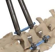 TLIF - Invictus - ATEC Spine
