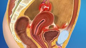 For instance, endometriosis stages don't correlate to how badly things like infertility or chronic pain affect a woman. Endometriosis Johns Hopkins Medicine