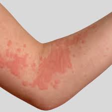 Image result for Hives