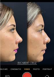 Recuperación de Rinoplastia de Preservación Ultrasonica en Perú