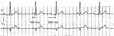 Image result for PR Interval