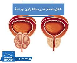 تخلص من تضخم البروستاتا في أفضل مكان يوفر لك أفضل خدمة صحية والعودة للمنزل في نفس اليوم حيث يقدم دكتور محمد شاكر علاجا لتضخم البروستاتا عن طر Shaker Prostate