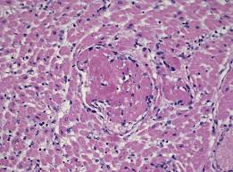 Diagnosis, management, and therapy of myocarditis: Covid 19 And Myocarditis A Systematic Review And Overview Of Current Challenges Springerlink