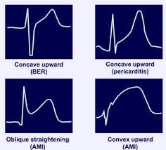 In such cases of cardiac tamponade, ekg or holter monitor will then depict electrical alternans indicating wobbling of the heart in the fluid filled pericardium, and the capillary refill might decrease. Ecg Changes In Pericarditis Epomedicine