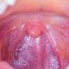 What throat cancer look like. 1