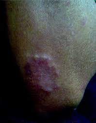 Shock jock joined 30th jun, 2012 · offline. Cutaneous Manifestations Of Infectious Diseases Abstract Europe Pmc