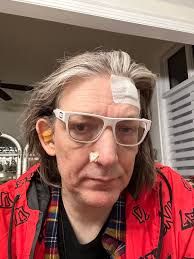 If you think I look bad, you should see the other guy. *edit* I'm fine. I  just had a little bit o' basil cell carcinoma. I had this thing growing