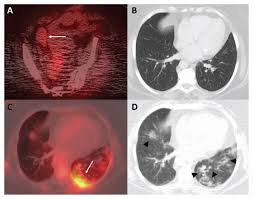 Incidental Covid 19 On Pet Ct Imaging Cmaj