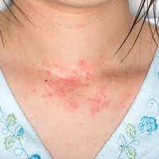 Guide To Allergic Skin Rashes