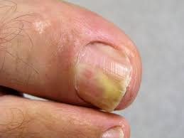 Image result for mykoza nehtů