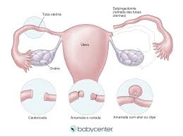 Posso fazer laqueadura junto com a cesariana? | BabyCenter