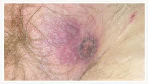Apply benzoyl peroxide or salicylic acid several times a day for a few days. Ecthyma Gangrenosum Caused By Psedumonas Aeruginosa
