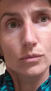 “In February 2018, symptoms became so severe that I went to the ER. Three  months later, I was diagnosed with peritoneal carcinomatosis, a type of  cancer extremely rare in someone my age. I was 33.”