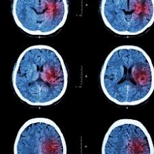 El accidente vascular cerebral transitorio es un cierre temporal del riego sanguíneo de una zona del cerebro con alteración. Accidente Cerebrovascular Isquemico Medlineplus En Espanol