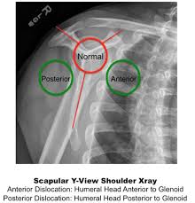 Pin By Miroslawa Bodnar On Pa Shoulder Dislocation Radiology Imaging Dislocation