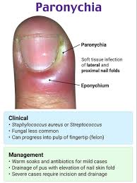 Image result for paronychium