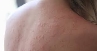 Image result for sweat rash on back