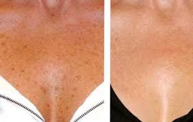 3 Natural Ways To Erase Brown Spots From Your Skin Brown Spots On Skin Skin Spots Getting Rid Of Freckles
