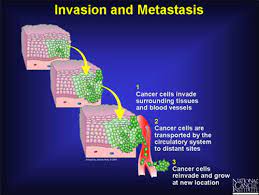 Not all cases of lung cancer will spread and cause secondary cancer. Cisn Metastatic Information