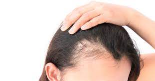 الصلع الوراثي عند النساء أسباب وعلاجات ويب طب