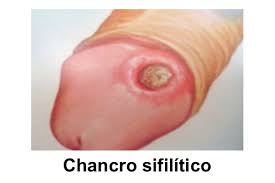 Ampollitas que se abren y forman llagas abiertas y dolorosas en los genitales. Ulceras Genitales Por Contacto Sexual Como Diferenciarlas