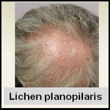 Lichen planopilaris is hair loss related to inflammation of the scalp that is progressive and can result in permanent hair loss. Pioglitazone For Treatment Of Lichen Planopilaris New Study Of 24 Patients Donovan Hair Clinic