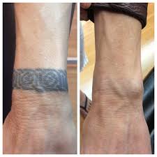 Whether you use a specific cream for tattoo removal, like wrecking balm, or a lightening cream, like skin doctors sd white, you i'm glad that you discovered that the only thing that really works to remove a tattoo is laser treatment. Safe And Professional Tattoo Removal In Massachusetts New York City