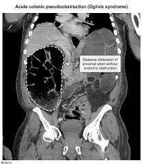 Image result for Adynamic Ileus