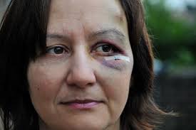 Cyclist injured as tree branch is thrown from York bridge