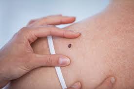 Skin cancer rates have soared by 45% in the uk over the last decade. Demystifying Skin Cancer Complete Family Dermatology