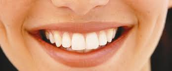 Veneers Schone Zahne Ohne Beschleifen Und Betaubung Asthetische Zahnheilkunde Frankfurt