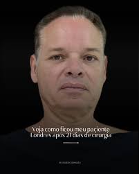 14 dias após cirurgia do Adrian Adrian cruzou o oceano vindo da Inglaterra  em busca de um rejuvenescimento que fosse além da estética — ele queria  recuperar estrutura, leveza e funcionalidade. Planejamos