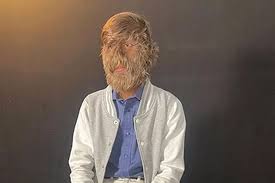 Image result for Hypertrichosis